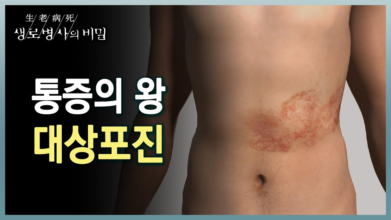 혹시 지금 이런 증상이? 피부에 수포가 나거나 몸 한 쪽에만 찌릿, 통증이 있으신가요? (KBS 20230222 방송 ...