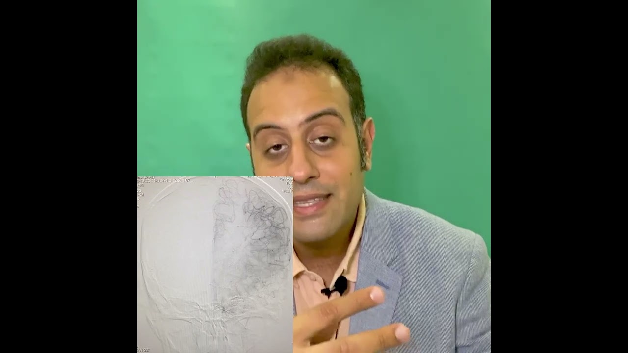 بالتفصيل : لماذا القسطرة التشخيصية لشرايين المخ اهم خطوة لمريض التشوه الشرياني الوريدي بالمخ