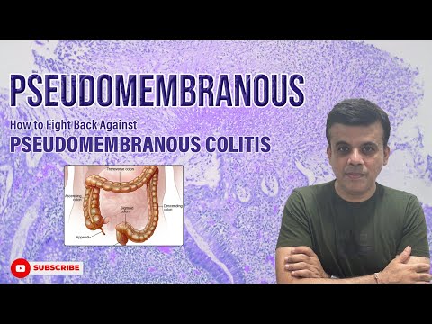 Are you aware of #Pseudomembranous Colitis facts? Watch now-# usmle, #neet pg, #plab, #fmge
