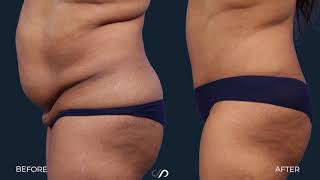 How Long Is Tummy Tuck Recovery? An Expert Shares Tips for How To