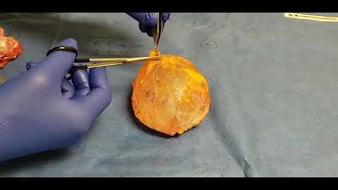 CAPSULAR CONTRACTURE! - Hard and Thick Capsule - Distorts Implant - Breast Implant Illness - BII