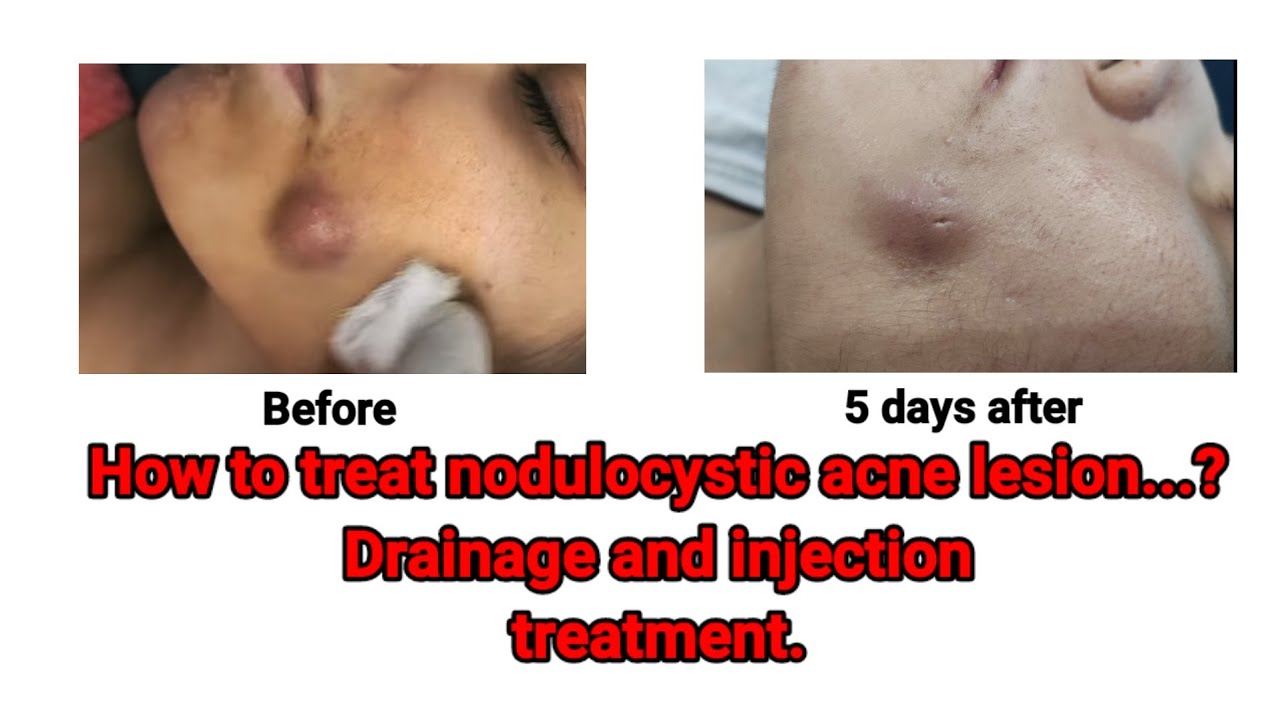 NoduloCystic Acne Treatment: Injection Therapy @DrArifMDDermatologist # ...