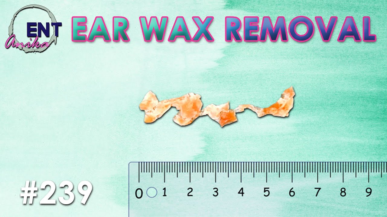 AnikaENT Extra Sticky Ear Wax Removal Sucked To Reveal A Healthy