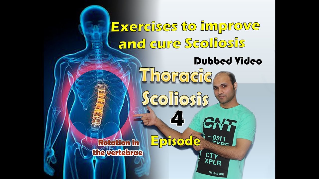 Thoracic scoliosis treatment Episode 4 rotation - YouTube