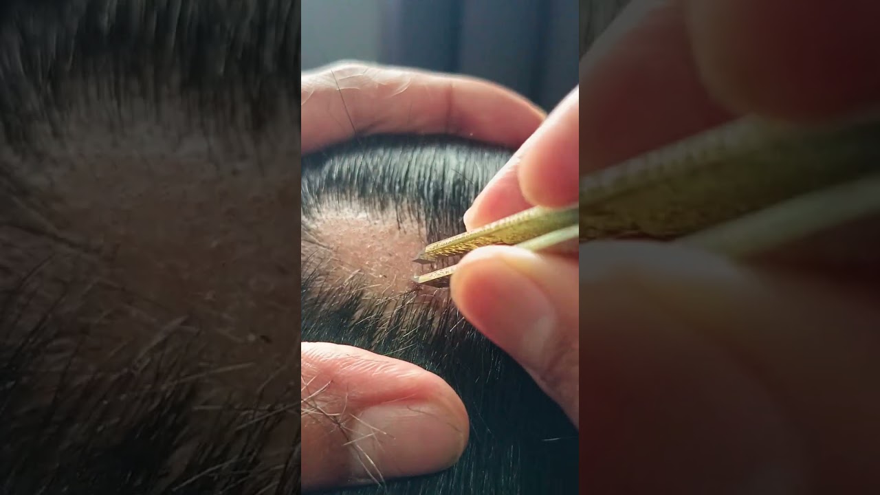 most satisfying white hair removal 0.73#stressremoval #satisfying #hairremoval