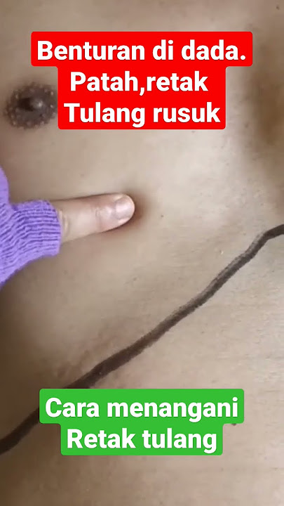 benturan di dada.patah,retak tulang rusuk. menangani retak tulang.#benturan #shorts #vidioshorts