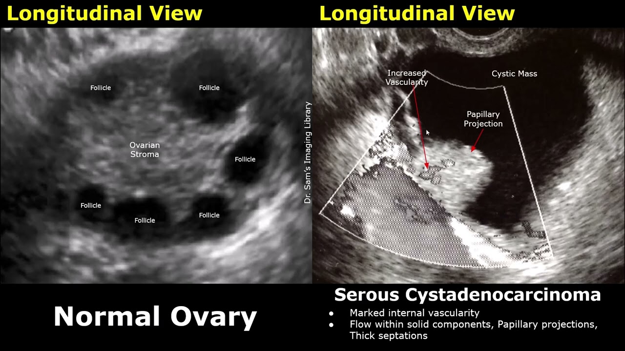 Gynecological Ultrasound Ovary Normal Vs Serous Cystadenocarcinoma | Ovarian Cancer USG Findings