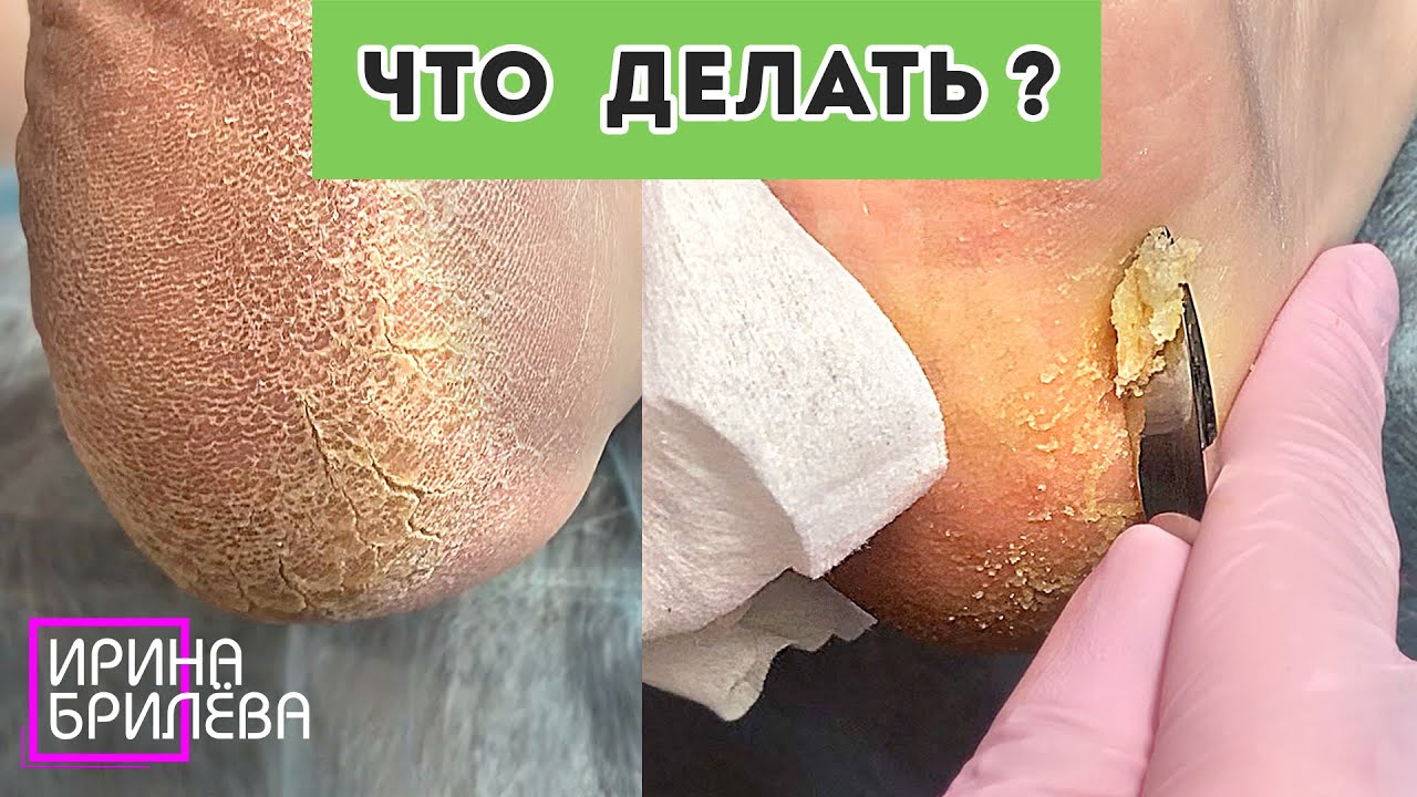 Когда ПЕДИКЮР пошёл...  не по плану 🌸 Ирина Брилёва