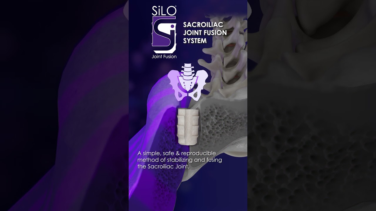 SiLO™ a single implant posterior SI fusion 