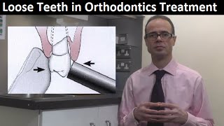 Do Orthodontic Braces, Brackets & Appliances Make Teeth Loose & Possibly Fall Out by Dr Mike Mew