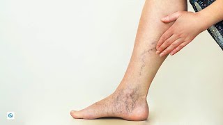 Лечение варикоза ног без операции