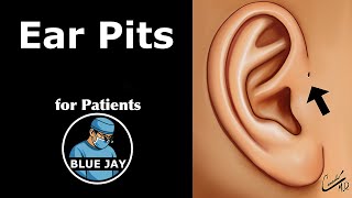 Ear Pits Patient Education
