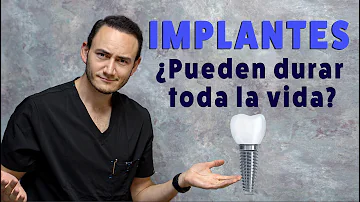 ¿Cuál es la vida útil de un implante?