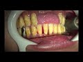 上尾の歯医者の歯周病・口臭予防の歯石取り動画 R5年7月21日 | 健康・口腔ケア