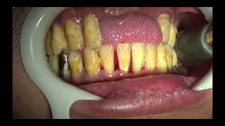 上尾の歯医者の歯周病・口臭予防の歯石取り動画 R5年7月21日 |  健康・口腔ケア