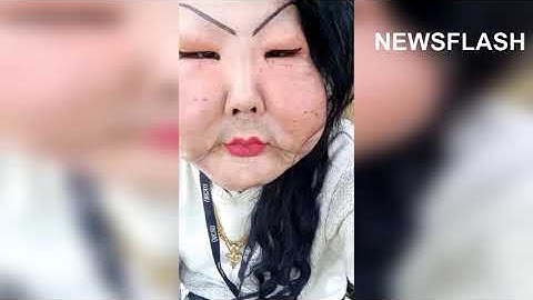 Woman Left With Droopy Cheeks After Failed Op