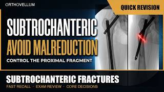 Subtrochanteric Fractures — Avoid Malreduction — Quick Revision (exam review)