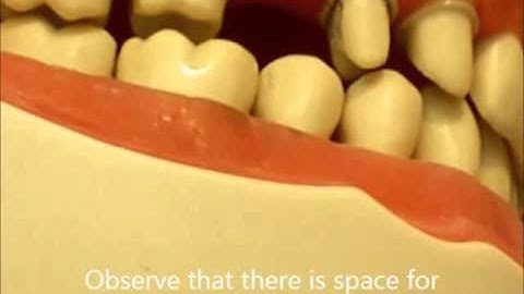 Fixed Partial Denture Path of Insertion