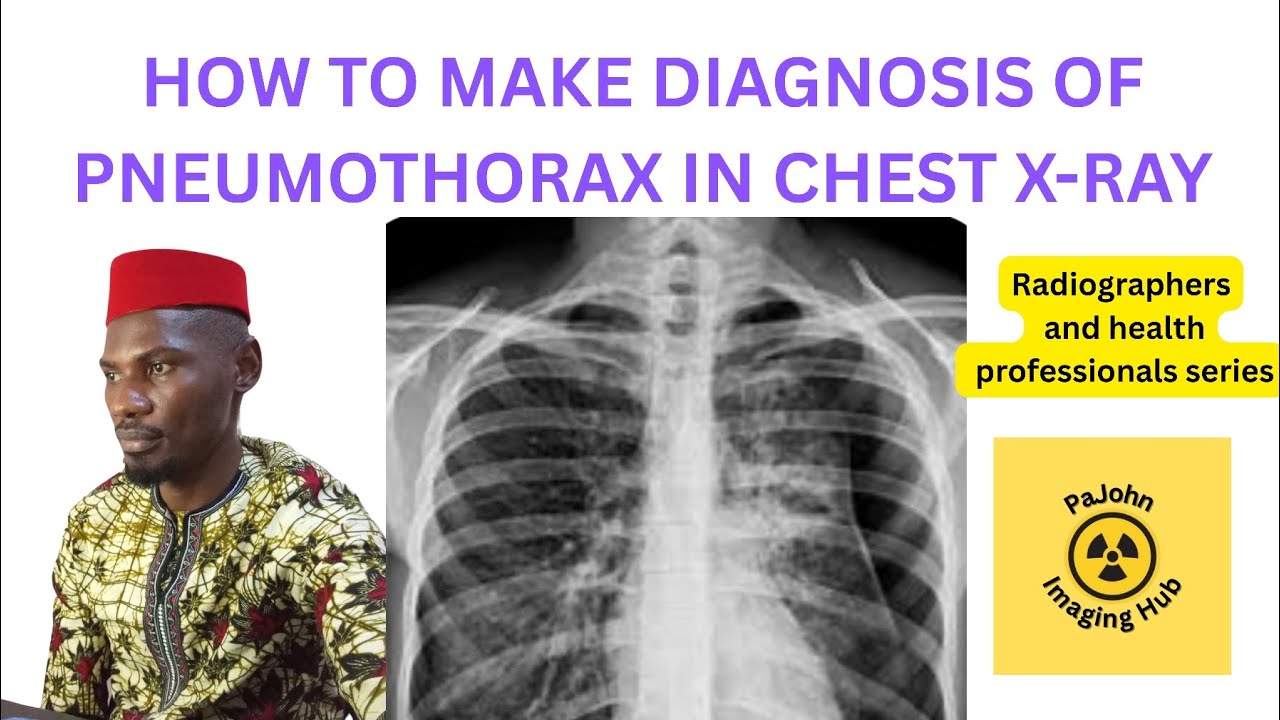 HOW TO MAKE DIAGNOSIS OF PNEUMOTHORAX IN CHEST X-RAY - YouTube
