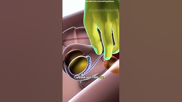Vasectomy procedure 3D animation #drone #theflash #space #automobile #scifi #science #3danimation