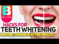 Braces Hacks to Keep Your Teeth White | Teeth Whitening with Braces and Invisalign