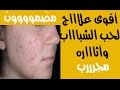 أقوى وأفضل علاج لحب الشباب وآثاره والنتيجة من أول أسبوع/( أقسم بالله مجررب)