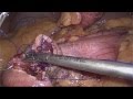 SINGLE ANASTOMOSIS DUODENOILEAL BYPASS WITH SLEEVE (HD 1080p, Audio) - Dr. V. AMAR, www.drvamar.com