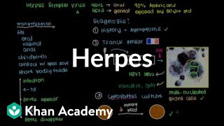 Diagnosis, treatment, and prevention of herpes | Infectious diseases | NCLEX-RN | Khan Academy