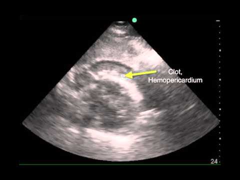 Video: Wat is een hemopericardium?