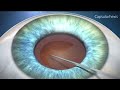 Cataract procedure tutorial  animation  standard optical  salt lake city ut