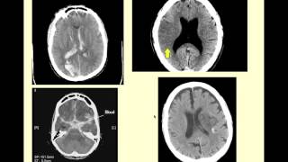 Stroke Syndromes  CRASH! Medical Review Series