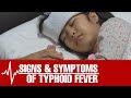 Signs and Symptoms of Typhoid Fever