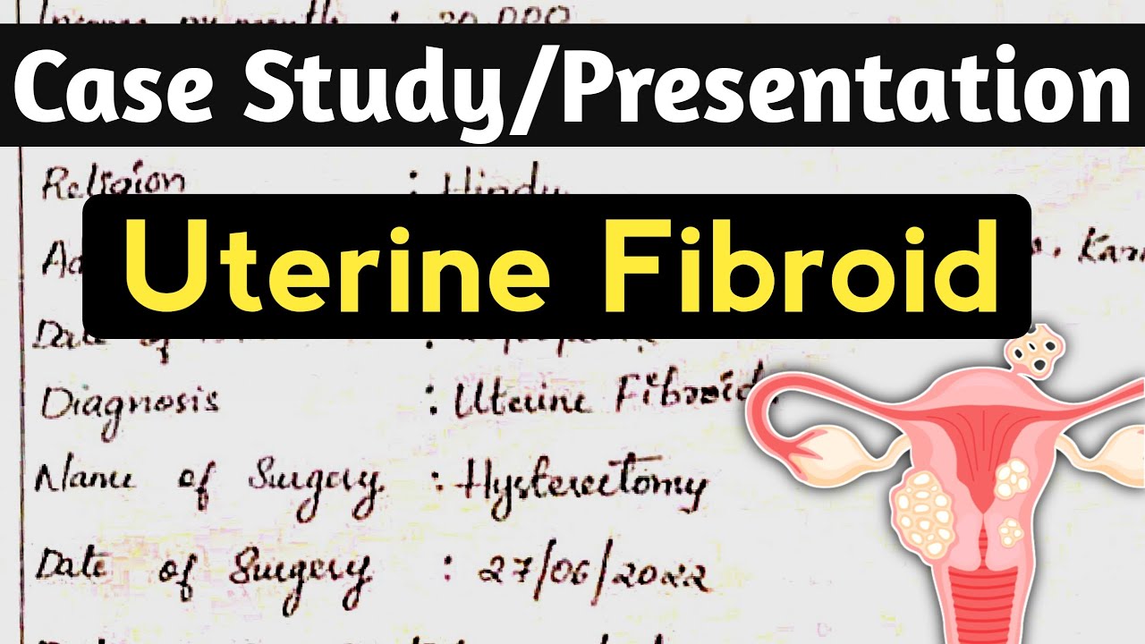 case study on fibroid uterus