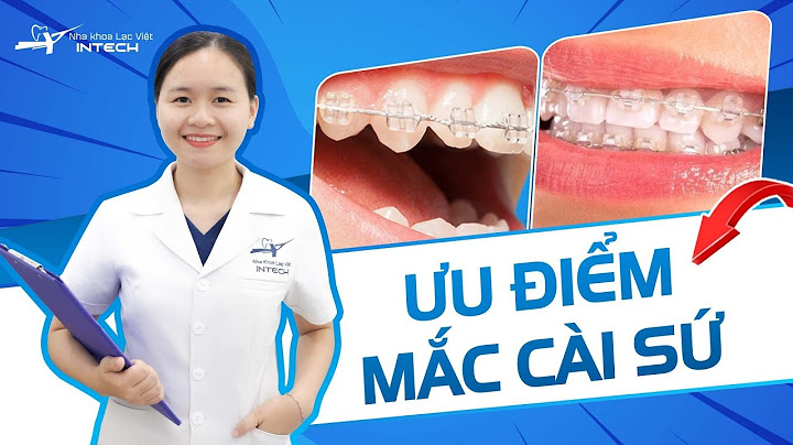 Niềng răng mắc cài sứ dây trong giá bao nhiêu