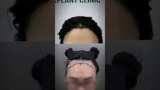 Cấy tóc sợi dài sau 8 ngày | CẤY TÓC BLACK HAIR