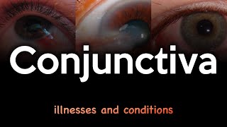 Conjunctiva: Illnesses and Conditions