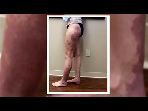 Como tratar Birthmarks Embarrassing