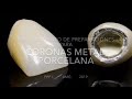 Preparación para corona metal porcelana