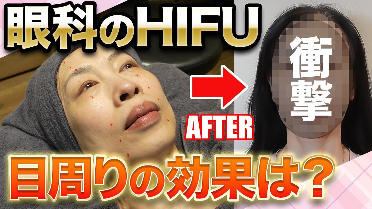 HIFU（たるみ治療）｜錦糸町駅直結の眼科 - 錦糸町眼科かじわら アイ
