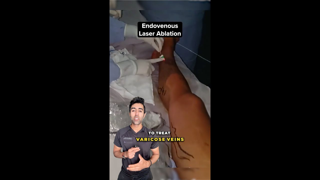 This Laser Treatment Can Make Varicose Veins Disappear