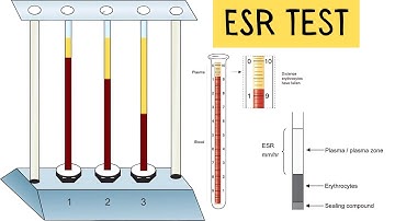 Erythrocyte Sedimentation Rate (ESR) Test What You Need To Know