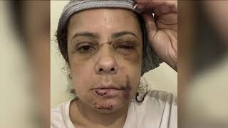 New Jersey Woman Who fought For Her Life During Trip To Turks And Caicos Hopes To Warn Travelers