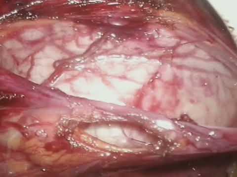 Laparoscopic Right Pyeloplasty