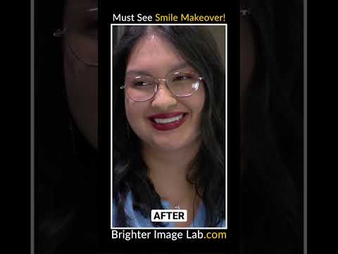 Cosmetic Dental Veneers