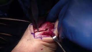 Youngswick Osteotomy Fixation with the BioPro Go-EZ Cannulated Screw