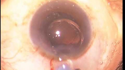 Releasing a Stuck Trailing Haptic of IOL