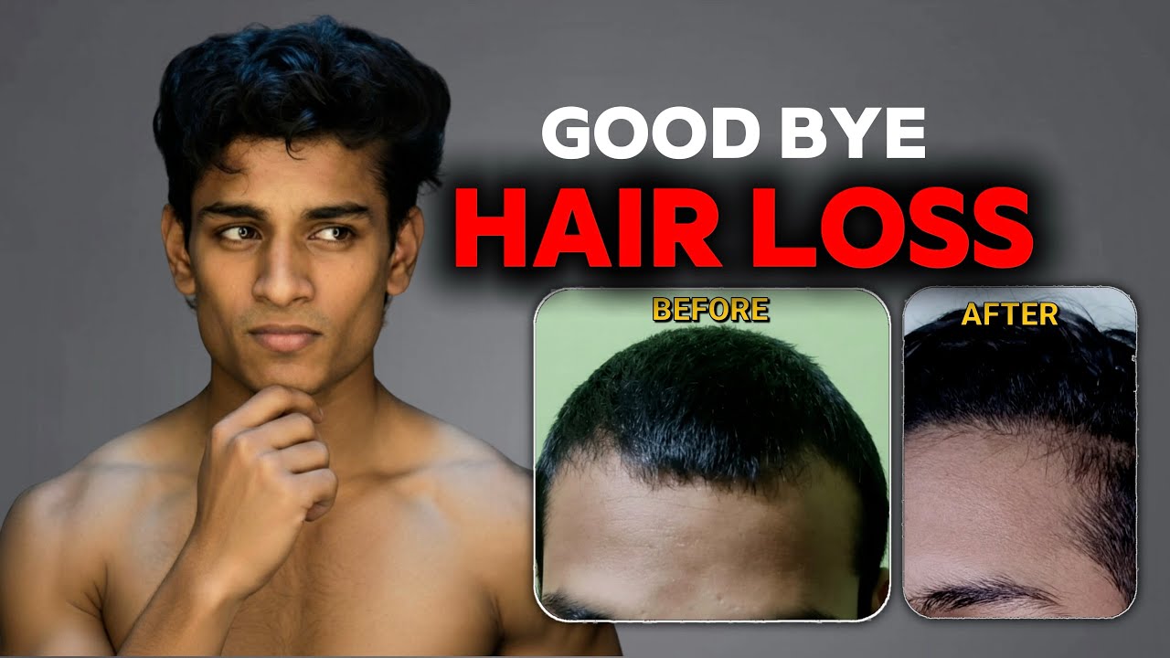 How I reversed my genetic hairloss 🧬.