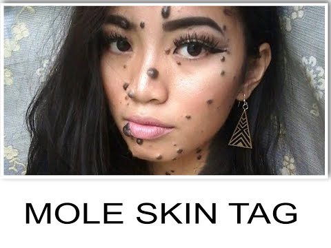teen-bullied-&-humiliated-because-of-mole-skin-pimple-finds-sugar-land-houston-texas-plastic-surgeon