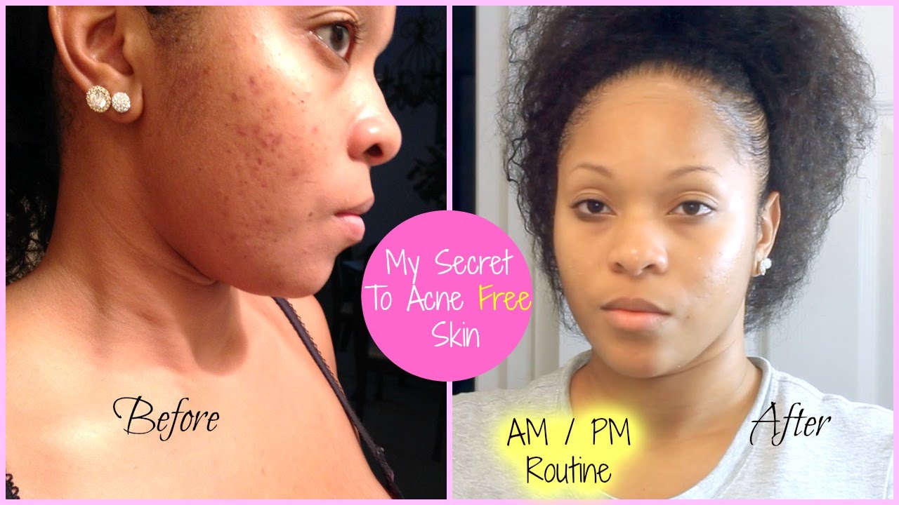 Skincare Routine For Acne Scars | Hairsstyles.co