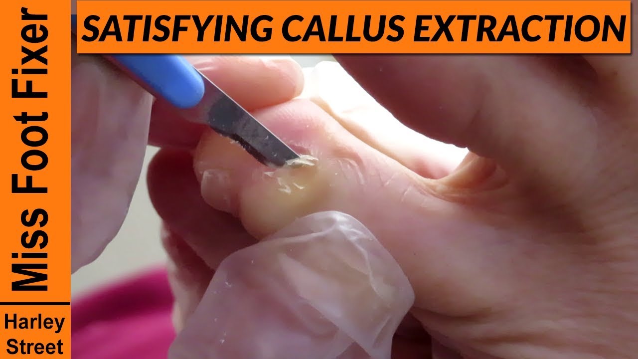 This Foot Callus Removal  Channel Is Equally Disgusting and  Satisfying to Watch
